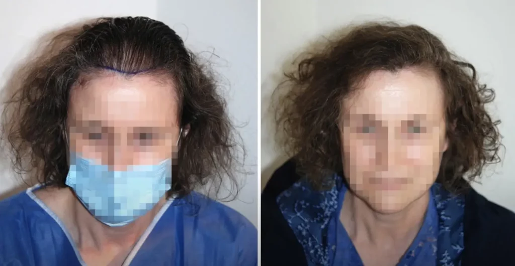 Haartransplantation Frauen ohne Rasur Schwachstelle Scheitel
