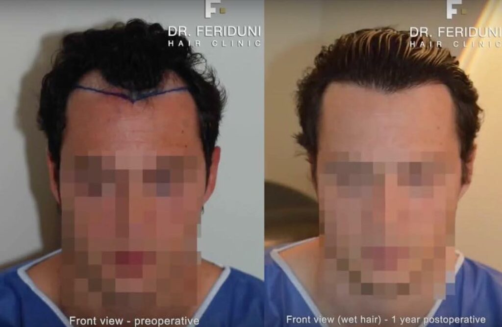 Haartransplantation Geheimratsecken Vorher Nachher Vergleich