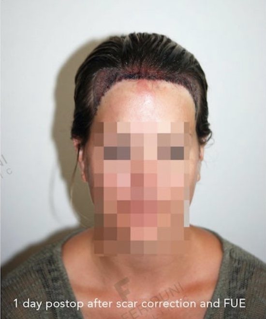 Haartransplantation bei Frauen ohne Rasur Haare Empfangsfläche