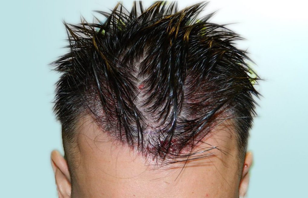 Haartransplantation ohne Rasur rasieren Vorher Nachher HOR.com