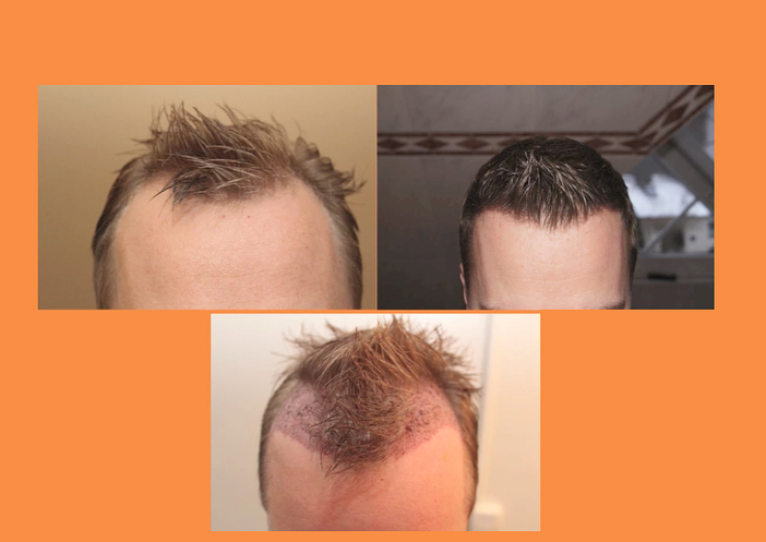Haartransplantation Geheimratsecken ohne Rasur Empfangszone